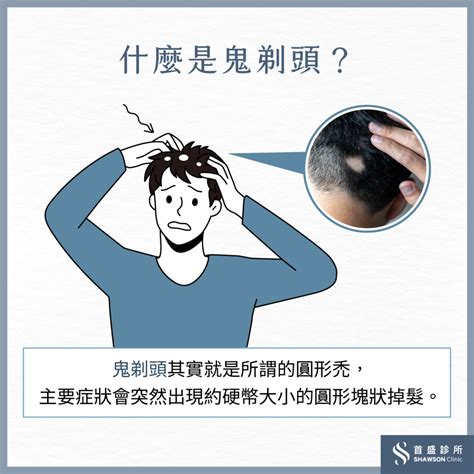 鬼剃頭|鬼剃頭／圓形禿會自己好嗎？多久會好？原因、治療解。